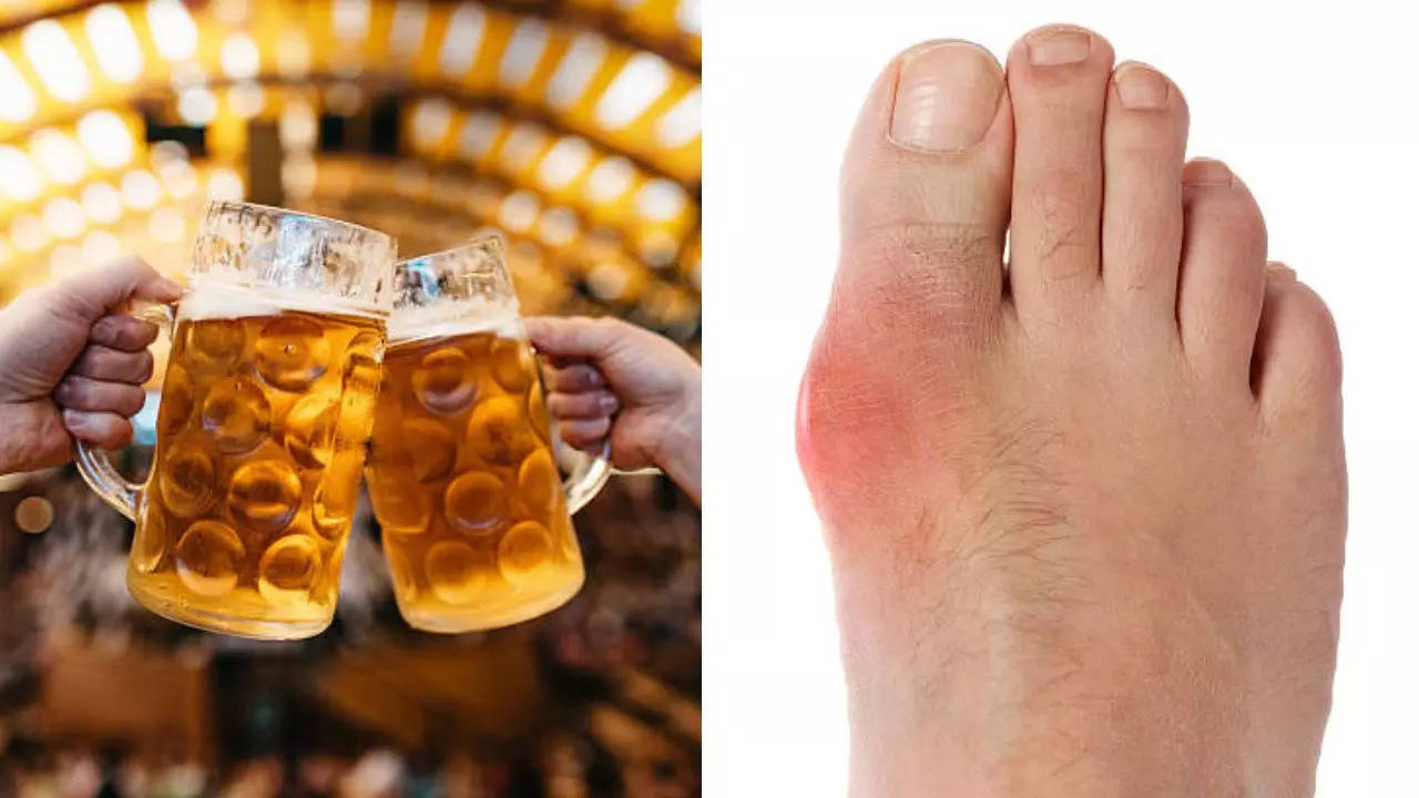 Beware! Drinking Beer, Champagne Can Cause Gout, A Painful Type Of Arthritis