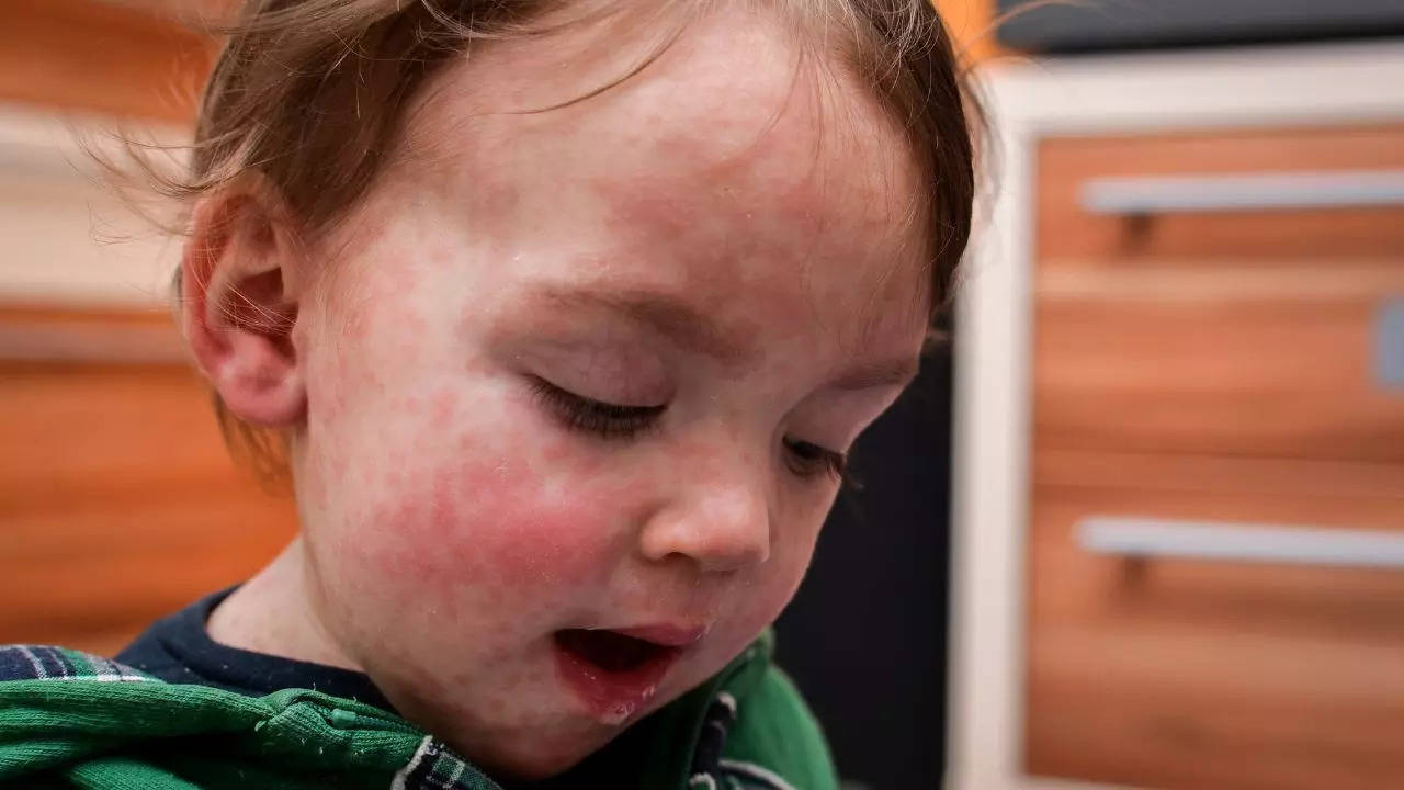 oregon witnesses largest measles outbreak in years amid national surge; know symptoms, complications and more