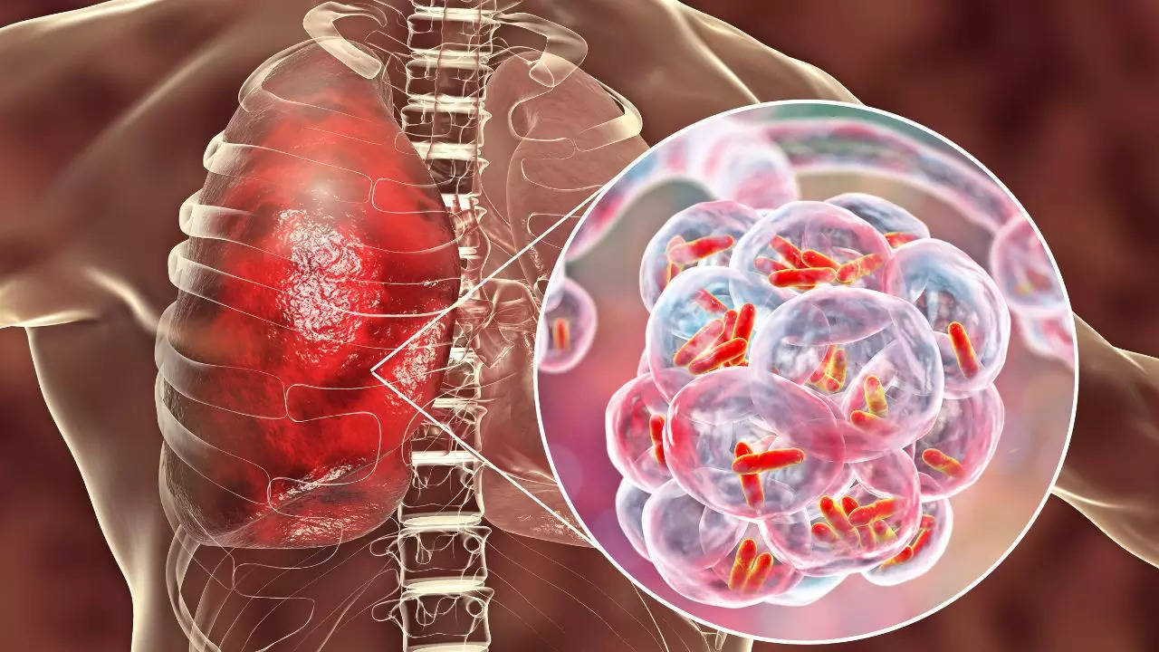 Pneumonia: Symptoms, Types, Complications And More About The Infection