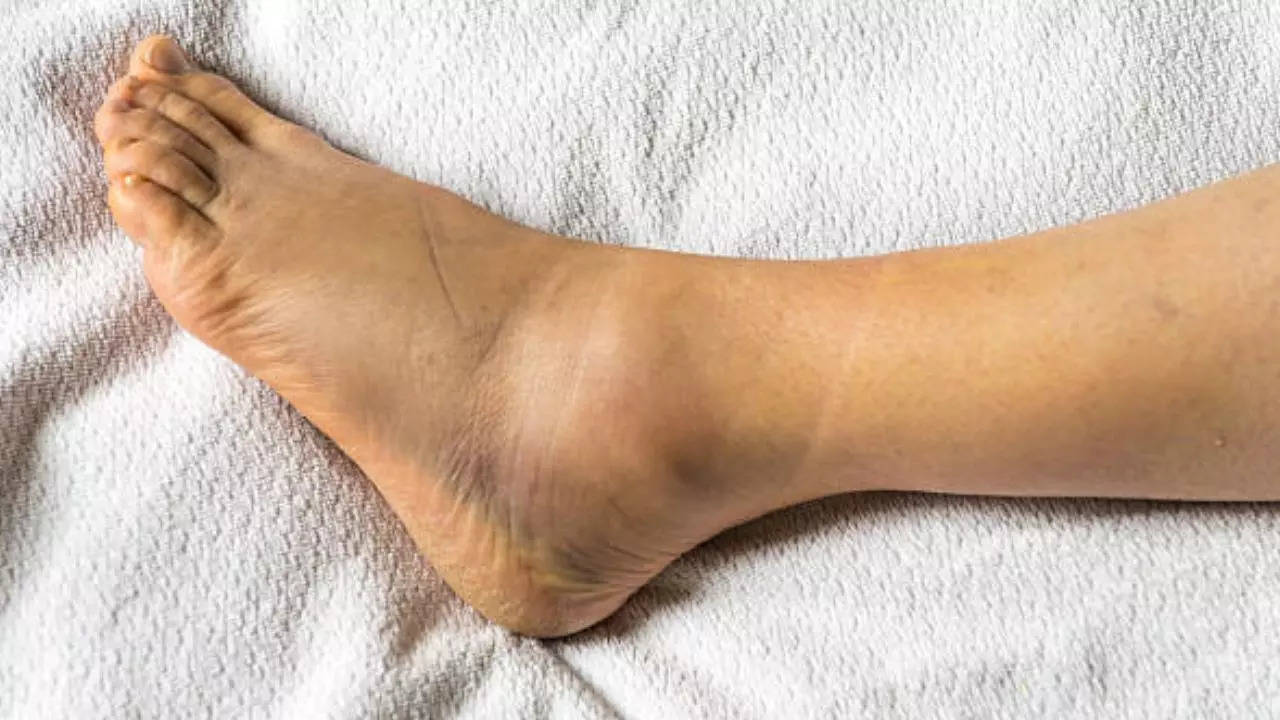 From Heart Failure to Liver Cirrhosis – What Causes Swelling In Your Ankles?