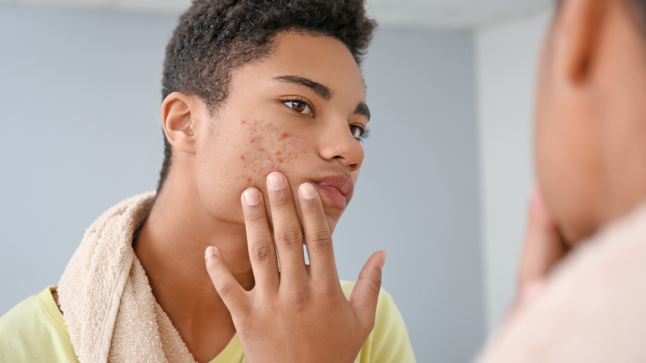 5 easy acne home remedies every man needs to try for clearer skin!