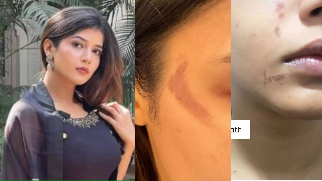 yeh rista kya kehlata hai samridhii shukla shares disturbing face burn photos and video from her on set mishap