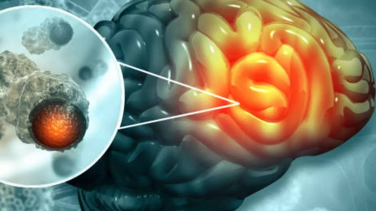 endoscopic brain surgery: how neurosurgeons are treating brain tumours without major incisions